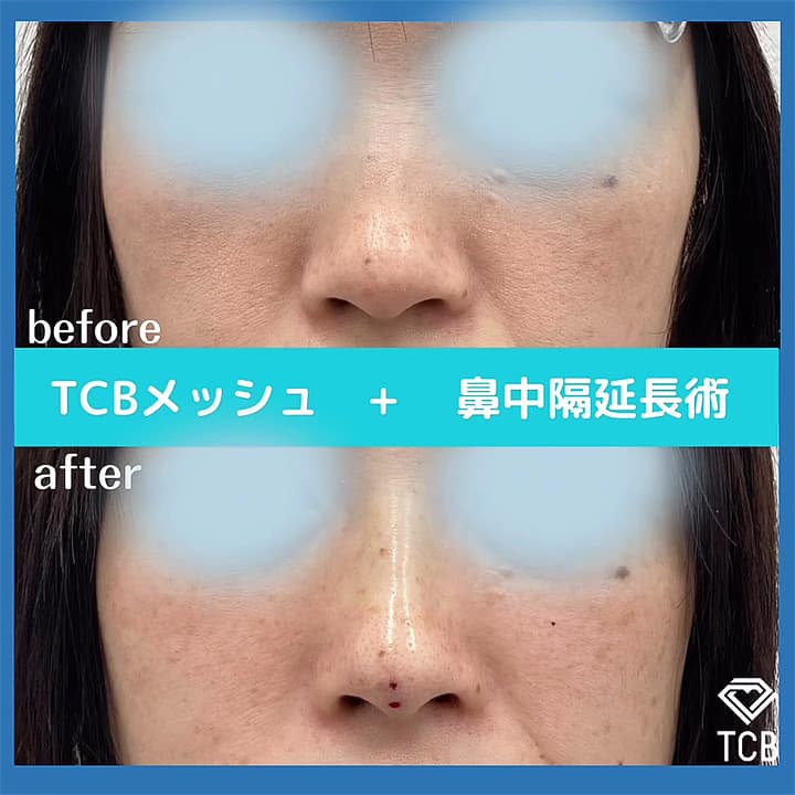 TCBメッシュの症例写真01