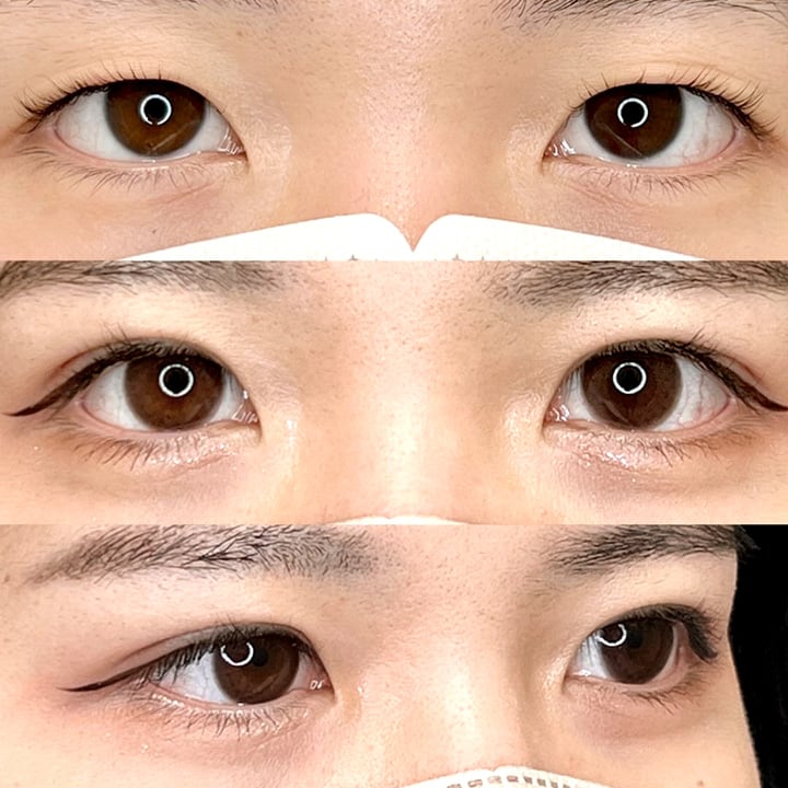 二重埋没の症例写真03