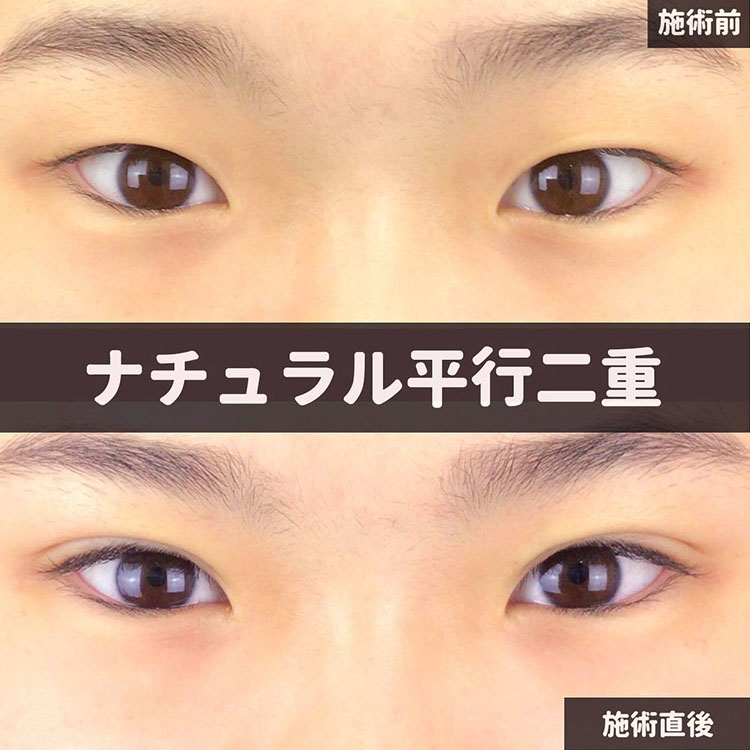 二重埋没の症例写真01