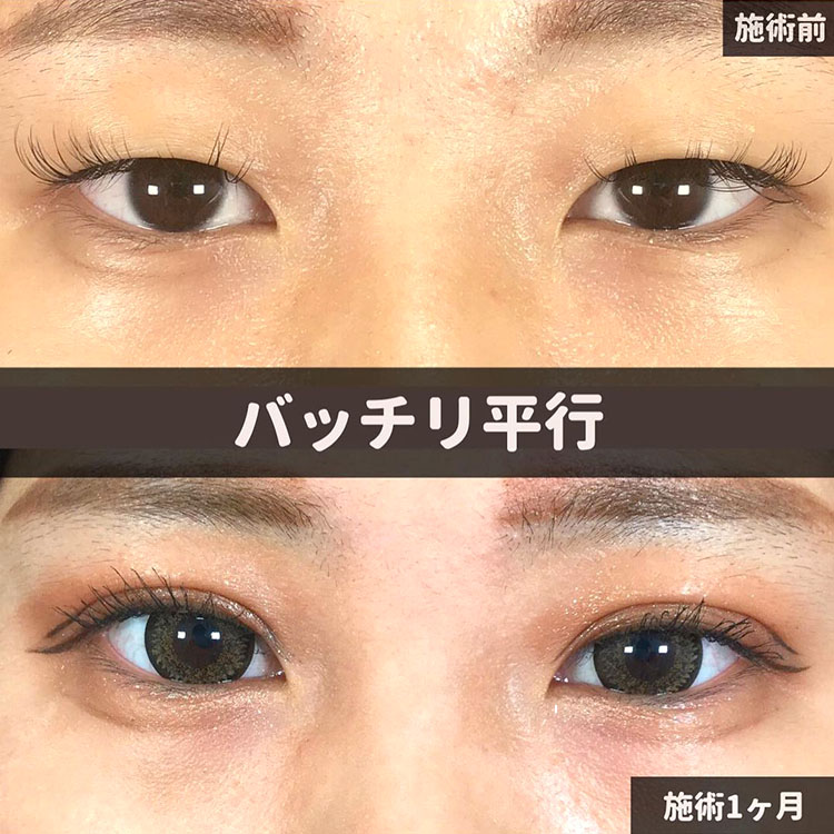二重埋没の症例写真02