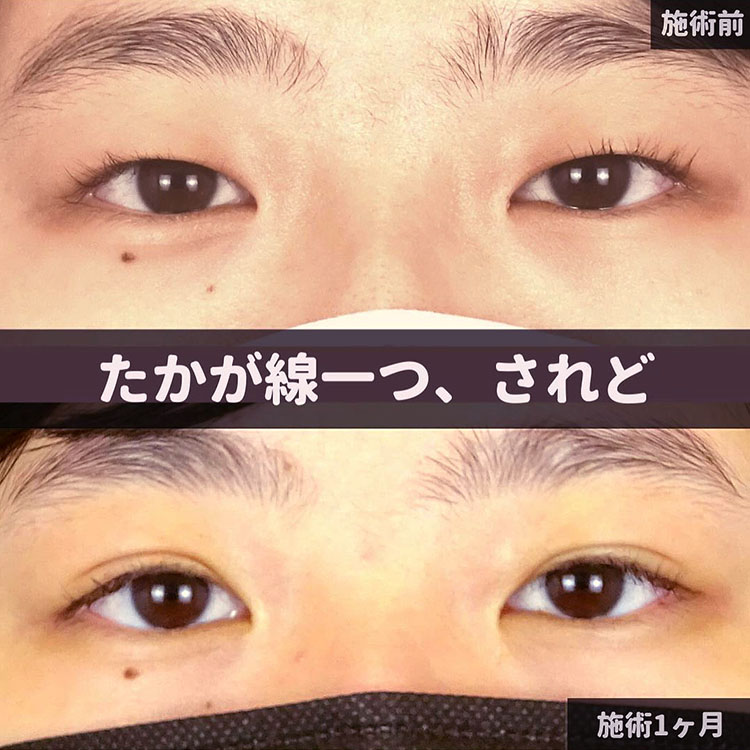 二重埋没の症例写真03