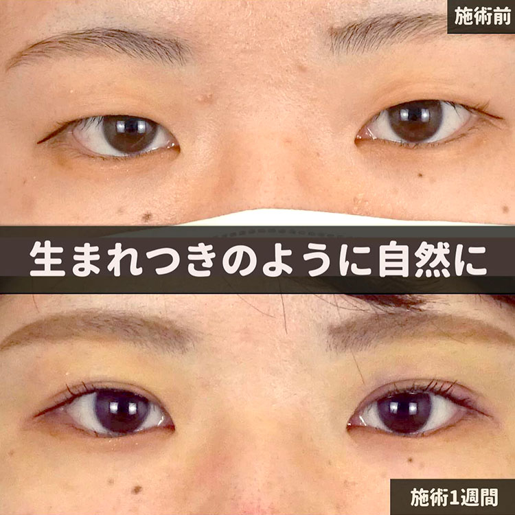 二重埋没の症例写真04