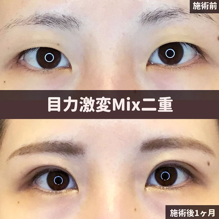 二重埋没の症例写真05