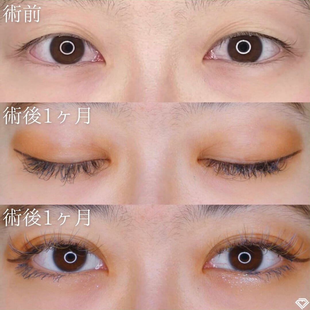 二重埋没の症例写真01