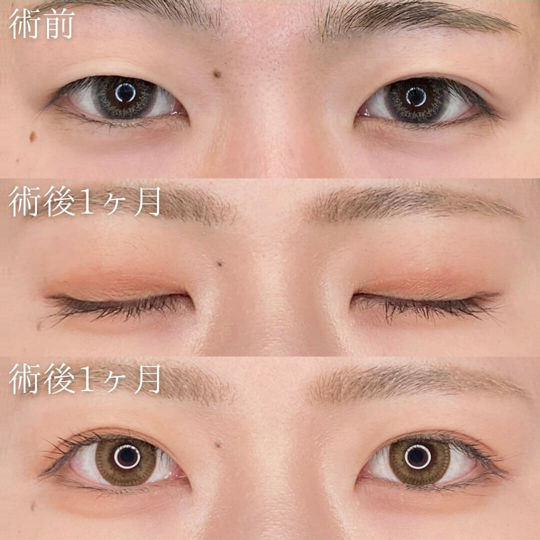 二重埋没の症例写真02