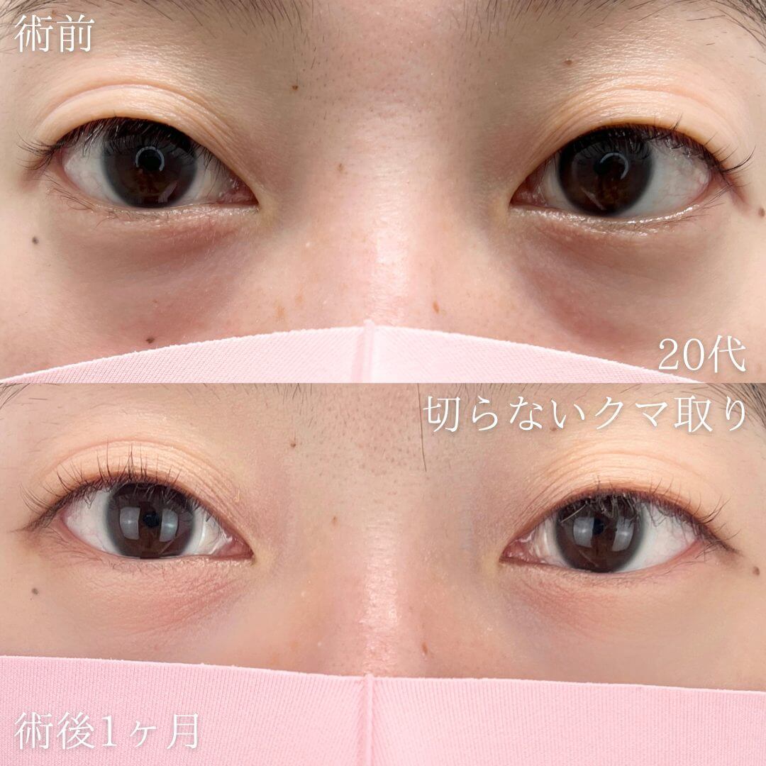切らない目の下のクマ取り・目の下のたるみ（ふくらみ）取りの症例写真01