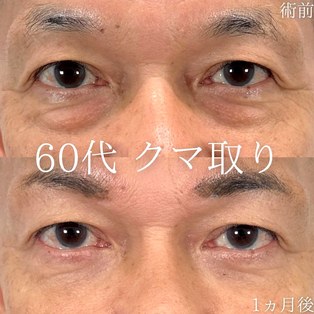 切らない目の下のクマ取り・目の下のたるみ（ふくらみ）取りの症例写真03