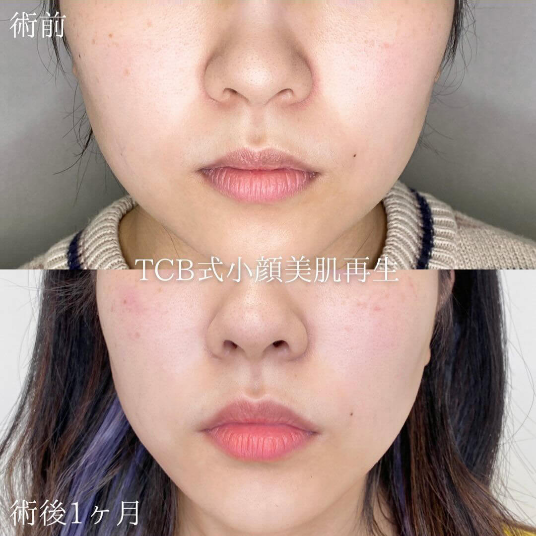 小顔美肌再生の症例写真01