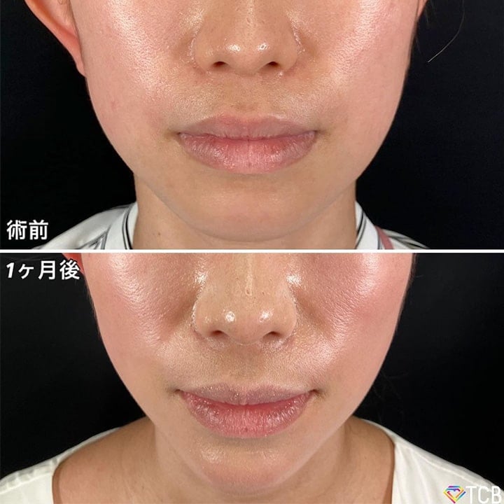 小顔美肌再生の症例写真02