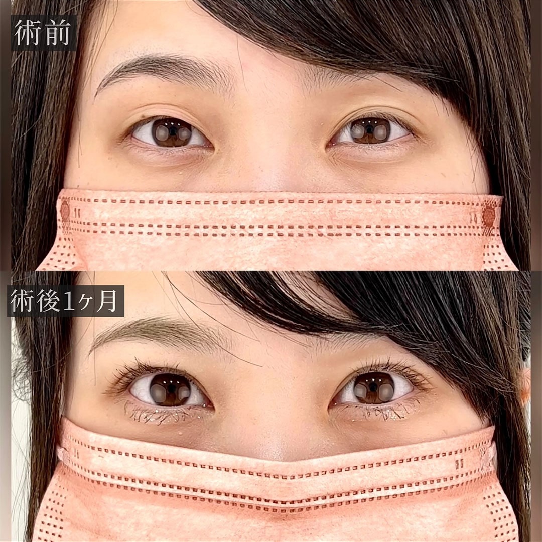 二重埋没の症例写真01