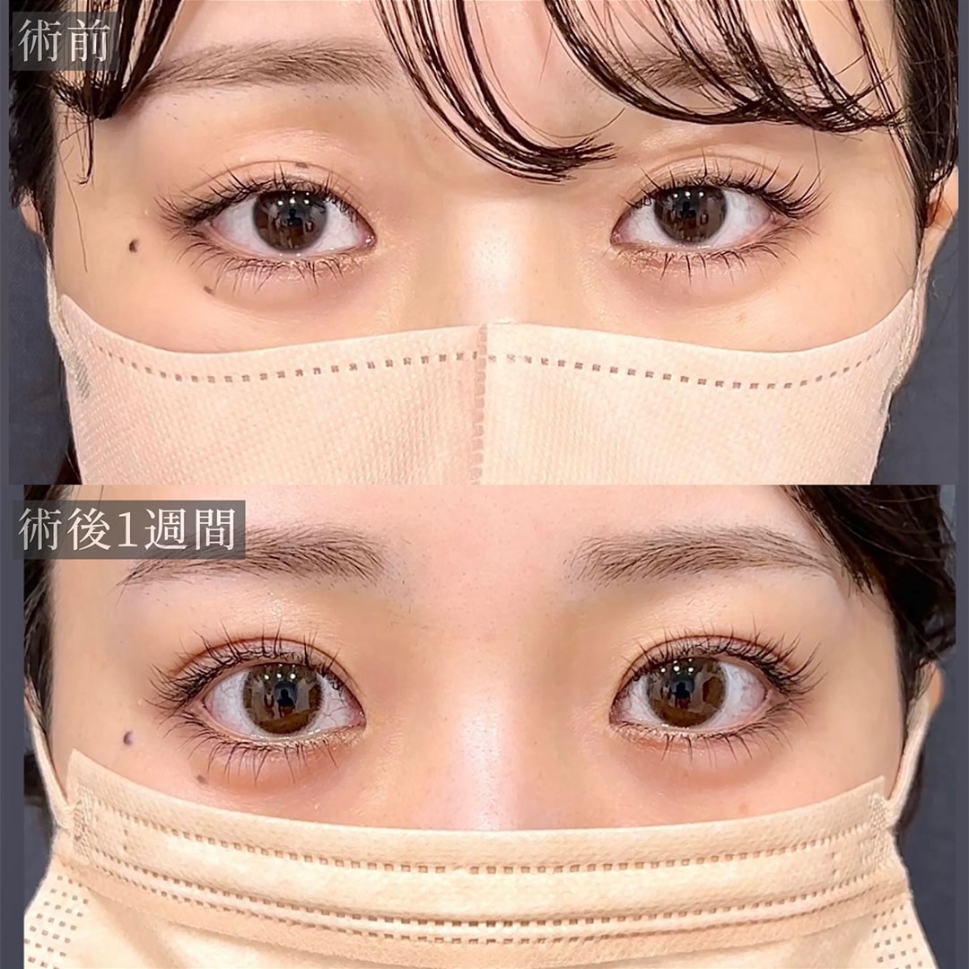 二重埋没の症例写真02