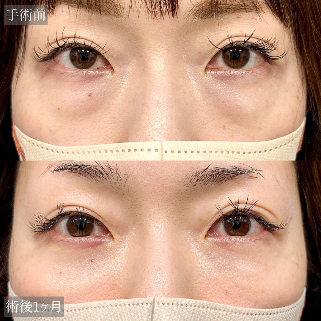 切らない目の下のクマ取り・目の下のたるみ（ふくらみ）取りの症例写真01