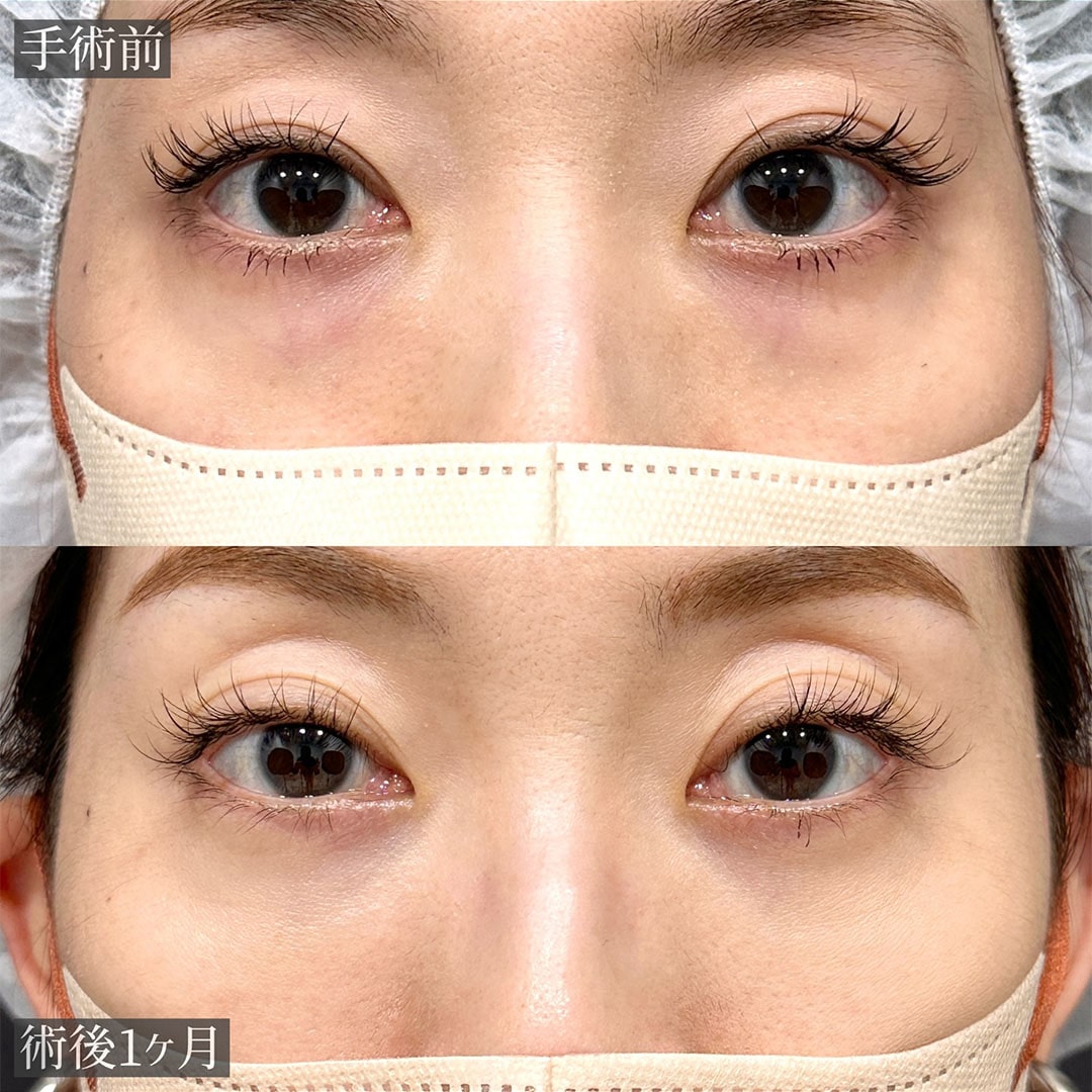 切らない目の下のクマ取り・目の下のたるみ（ふくらみ）取りの症例写真02