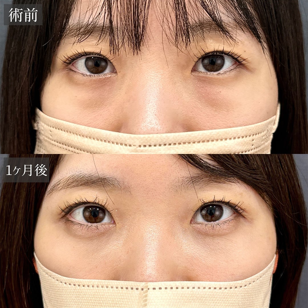 切らない目の下のクマ取り・目の下のたるみ（ふくらみ）取りの症例写真03