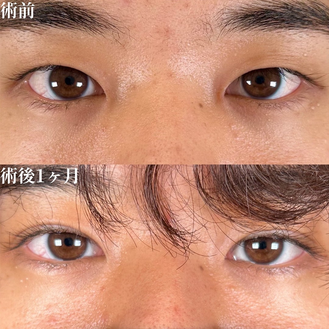 二重埋没の症例写真01