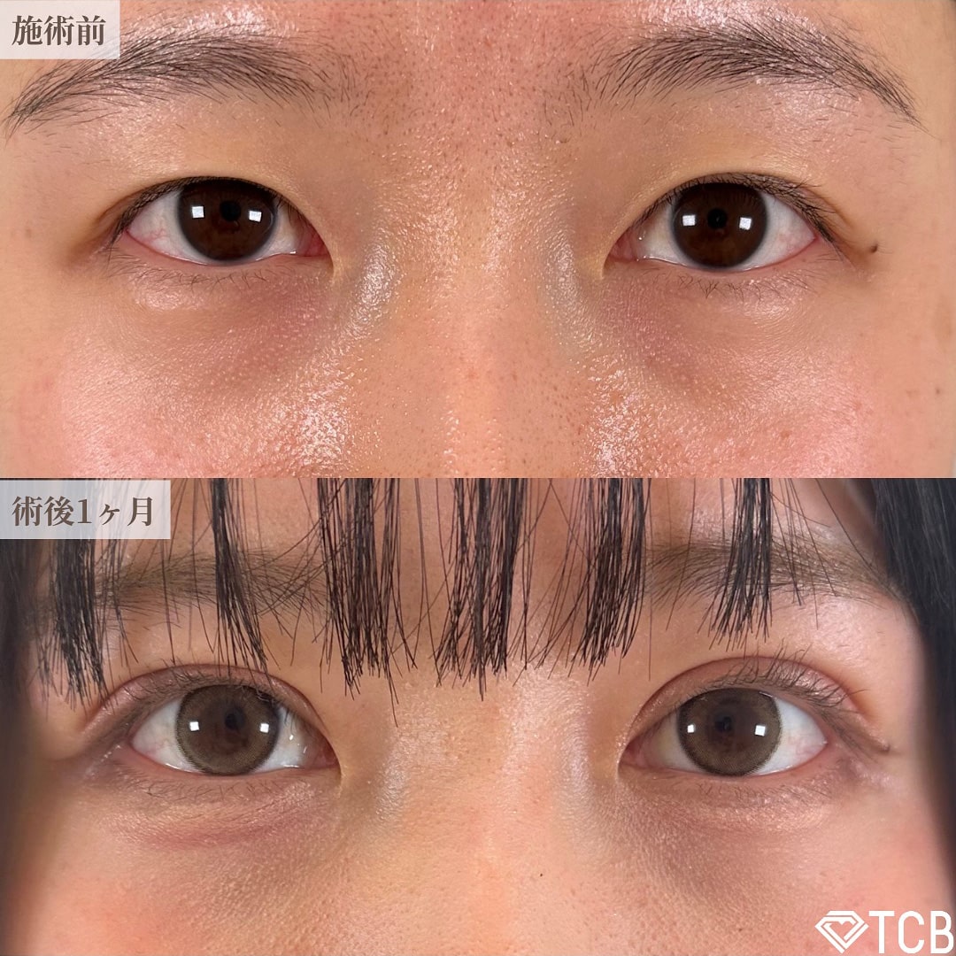 二重埋没の症例写真04