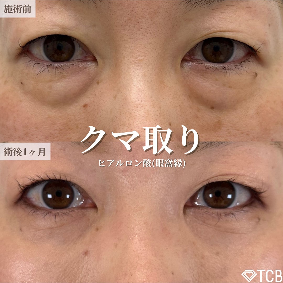 皮膚を切らない目の下のクマ取り・たるみ（ふくらみ）取りの症例写真01