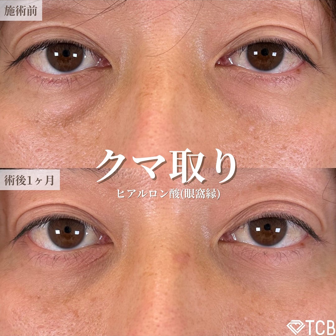 皮膚を切らない目の下のクマ取り・たるみ（ふくらみ）取りの症例写真02