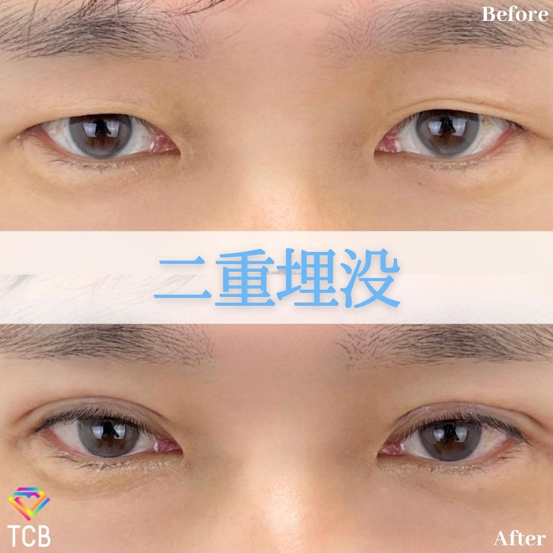 二重埋没の症例写真01