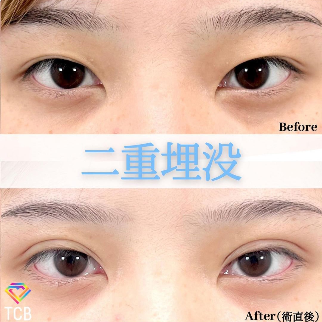 二重埋没の症例写真02