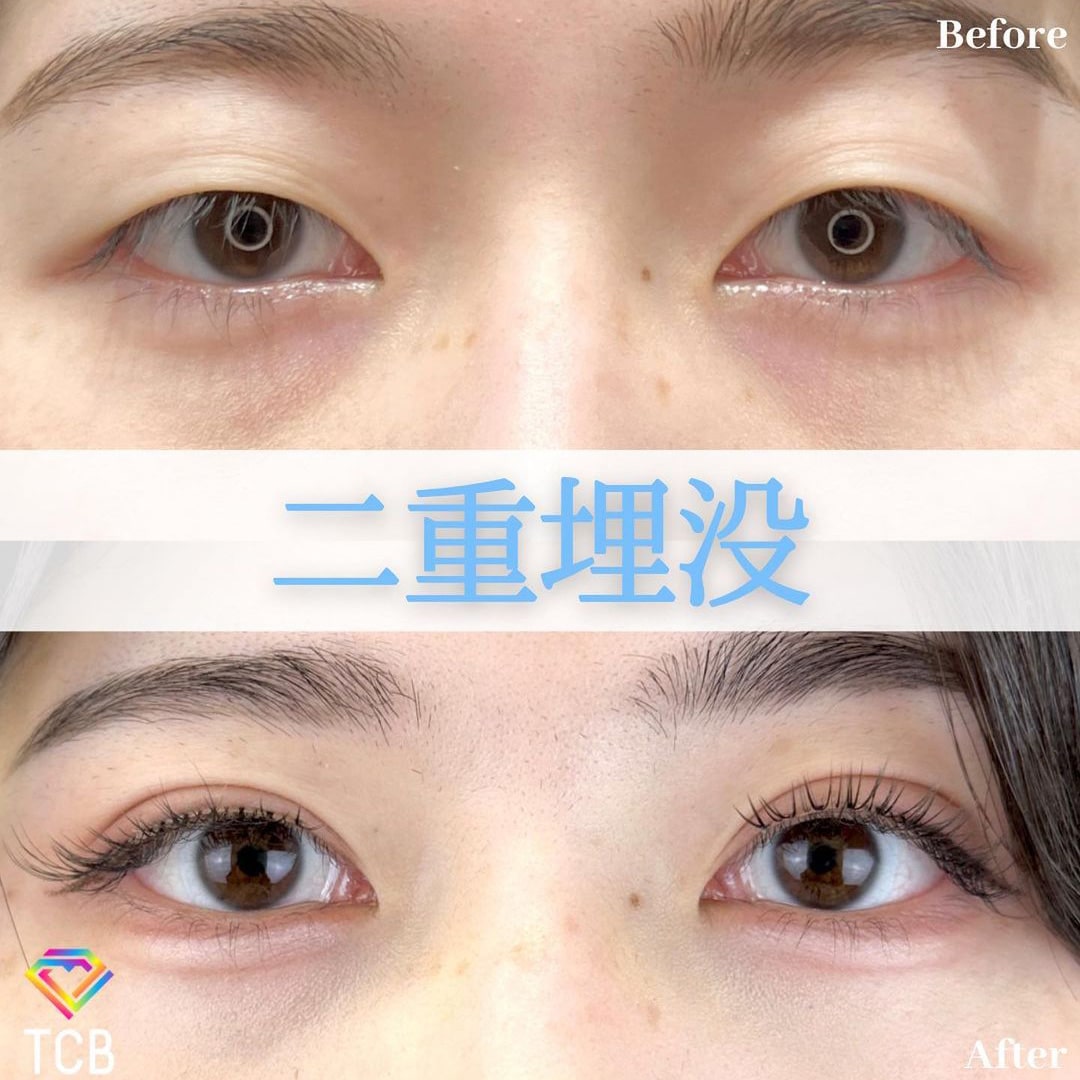 二重埋没の症例写真03