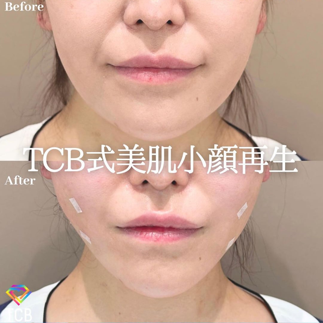 小顔美肌再生の症例写真01