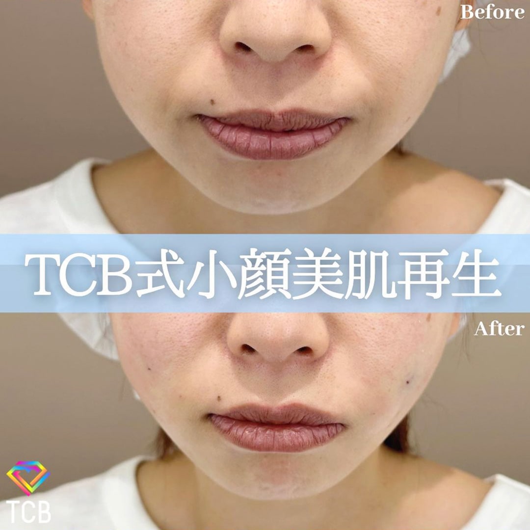 小顔美肌再生の症例写真02