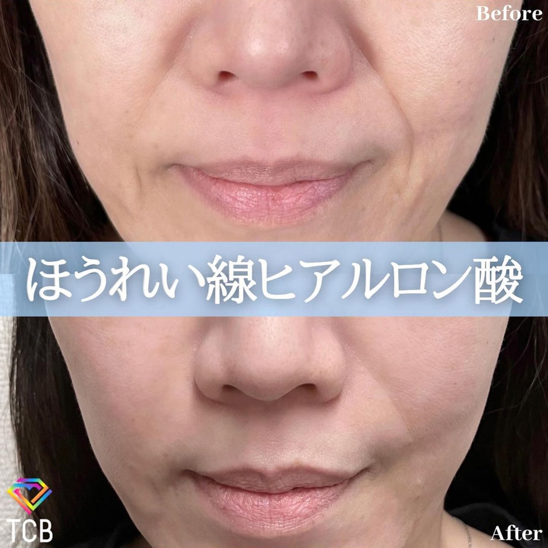ほうれい線のヒアルロン酸注射の症例写真01