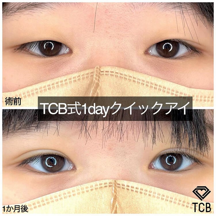 二重埋没の症例写真01