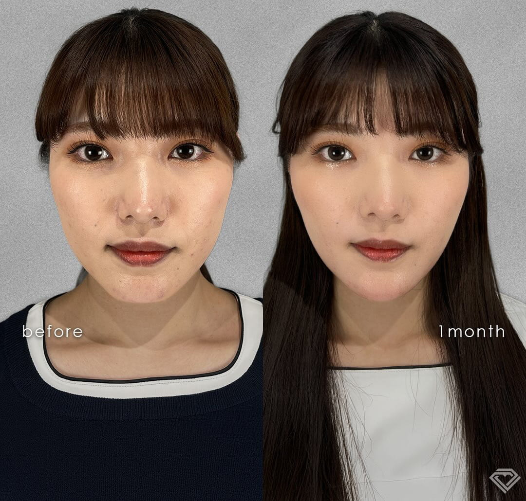 小顔美肌再生の症例写真01