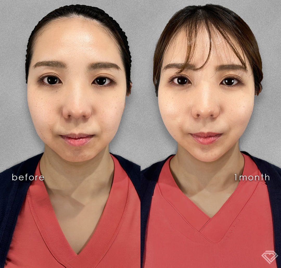 小顔美肌再生の症例写真02