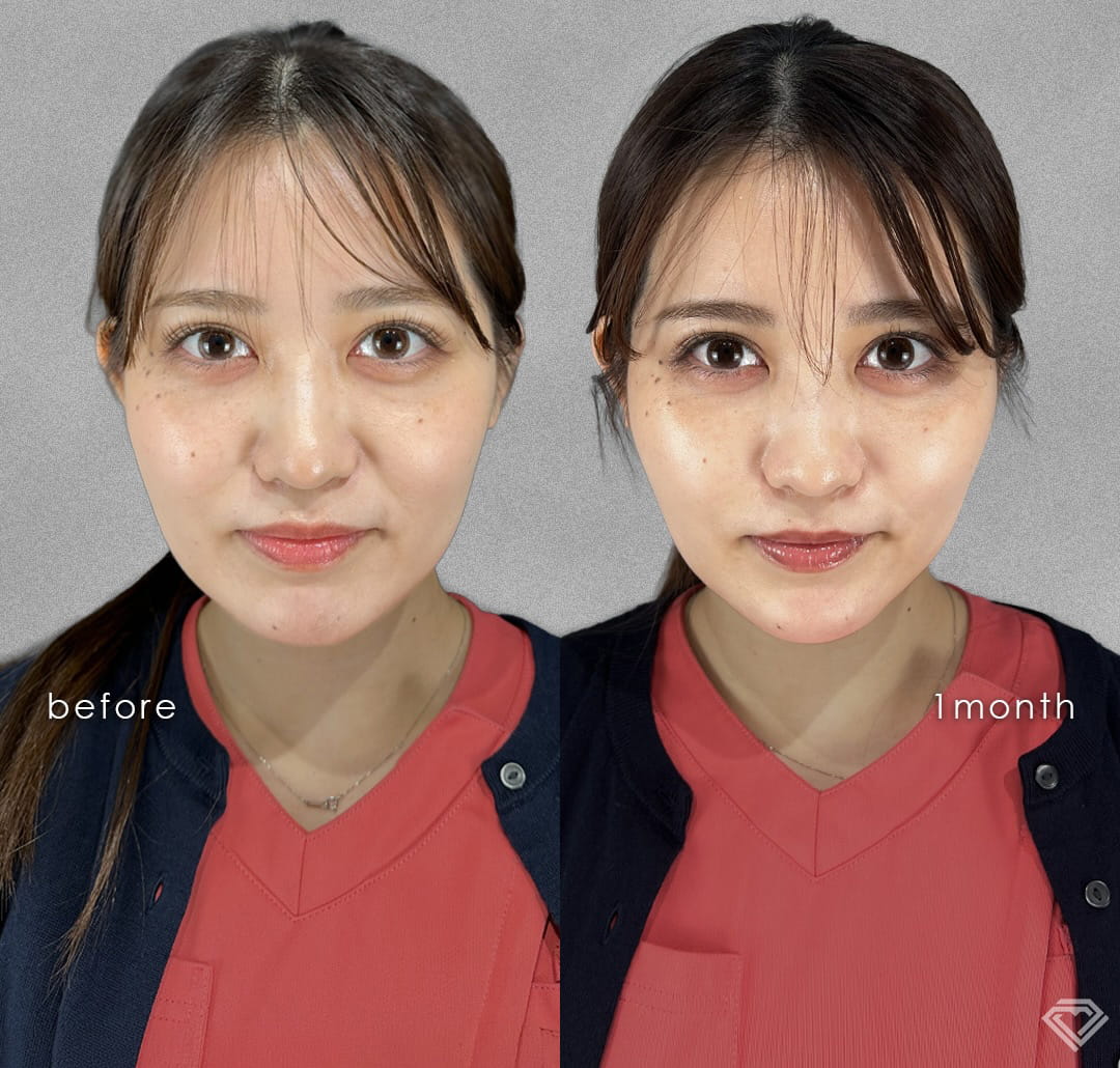 小顔美肌再生の症例写真03