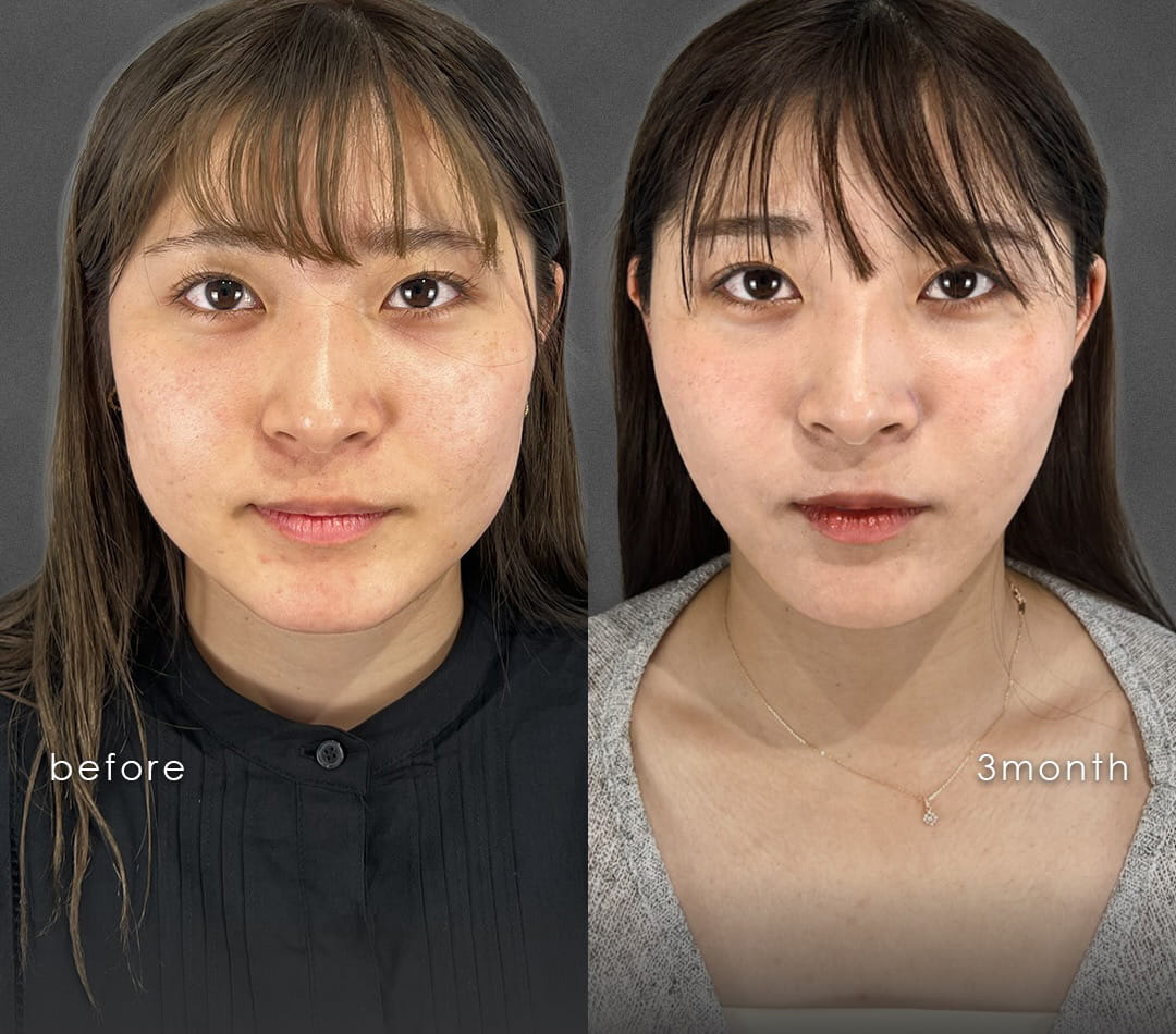 顔の脂肪吸引の症例写真01
