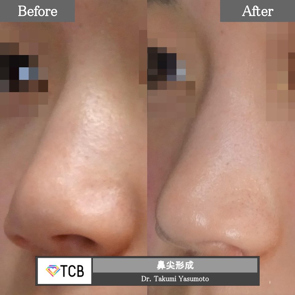 TCB鼻尖形成の症例写真01
