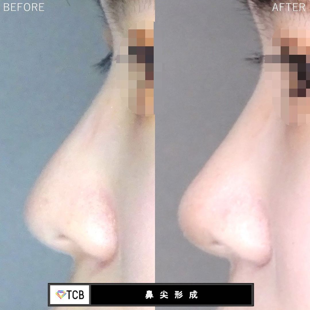 TCB鼻尖形成の症例写真02
