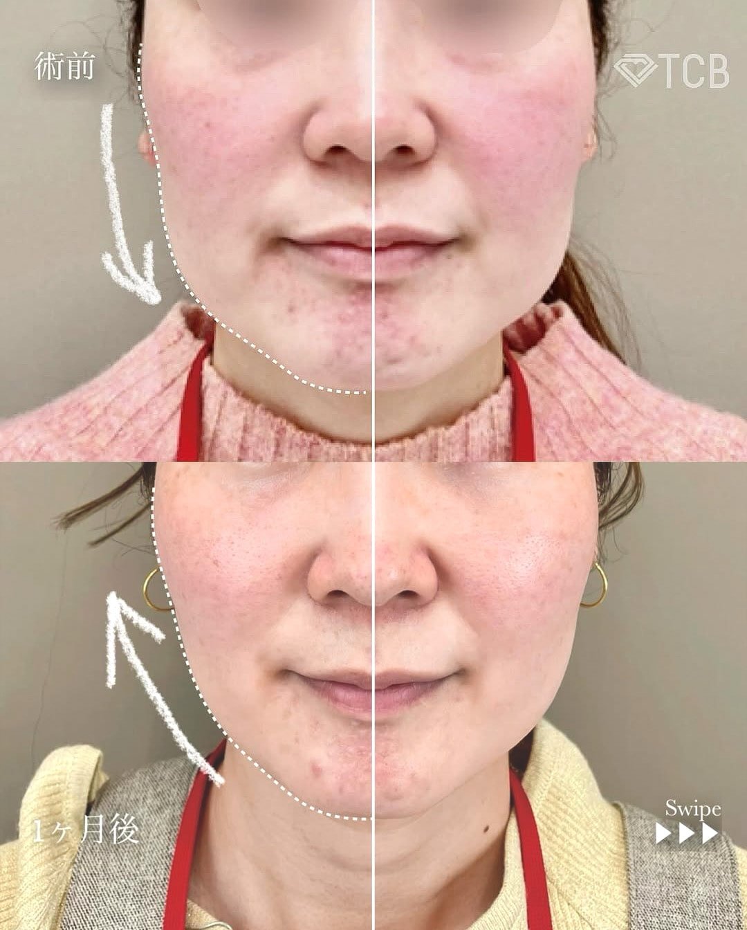 小顔美肌再生の症例写真01
