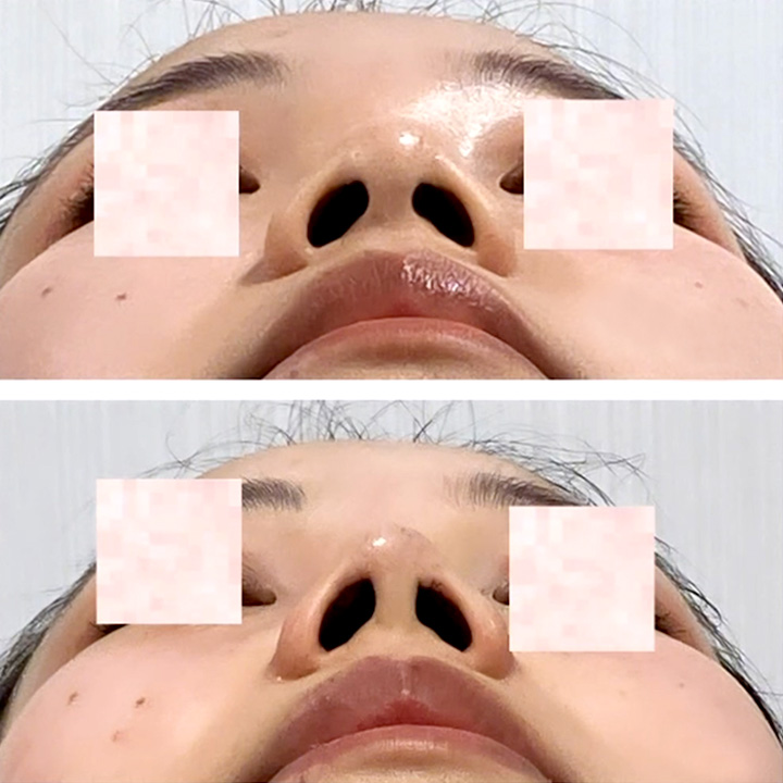 TCB式鼻先尖鋭術の症例写真01