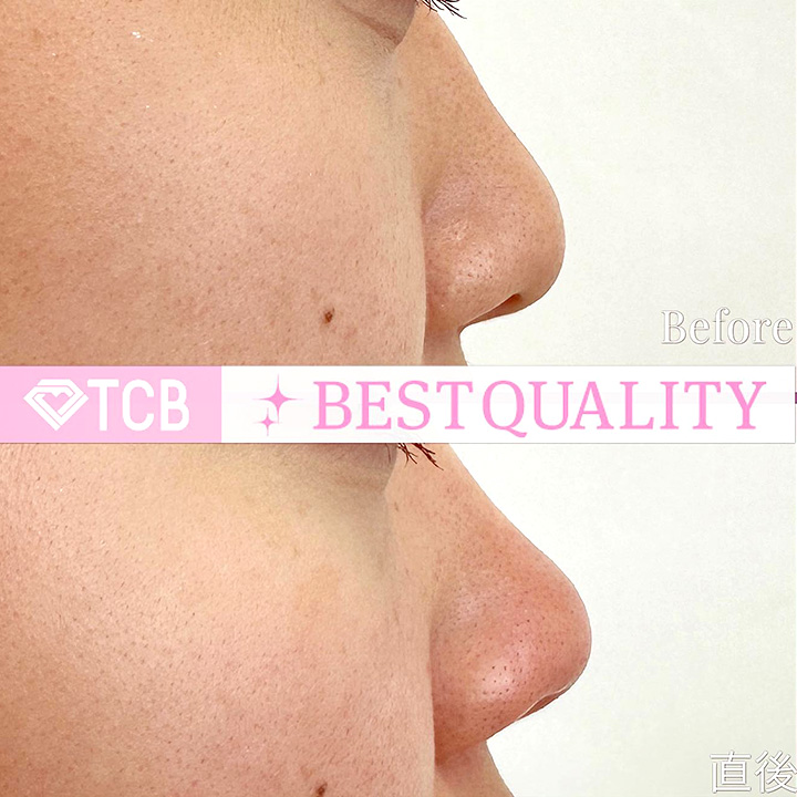 TCB式鼻先尖鋭術の症例写真02