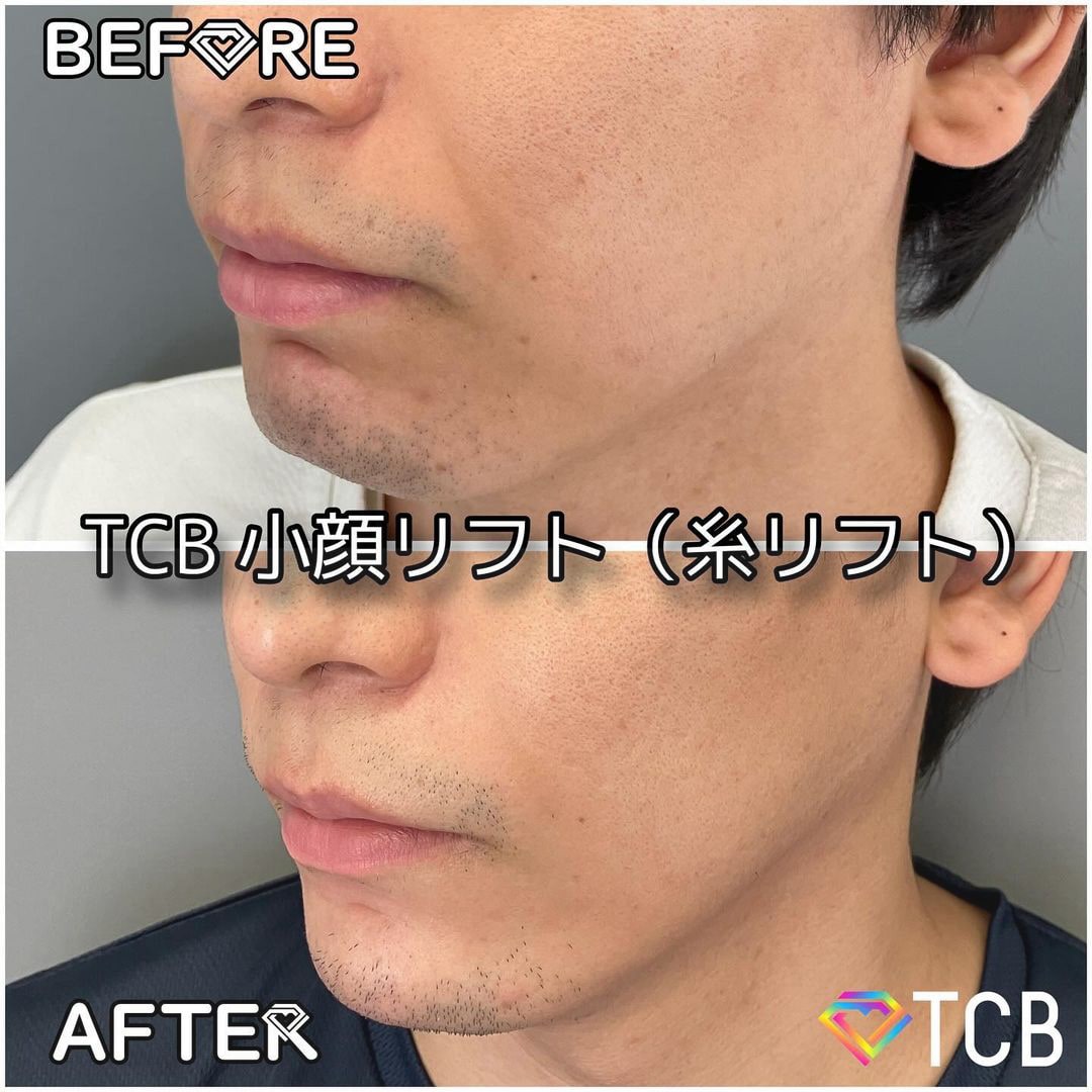 TCB小顔リフトの症例写真01