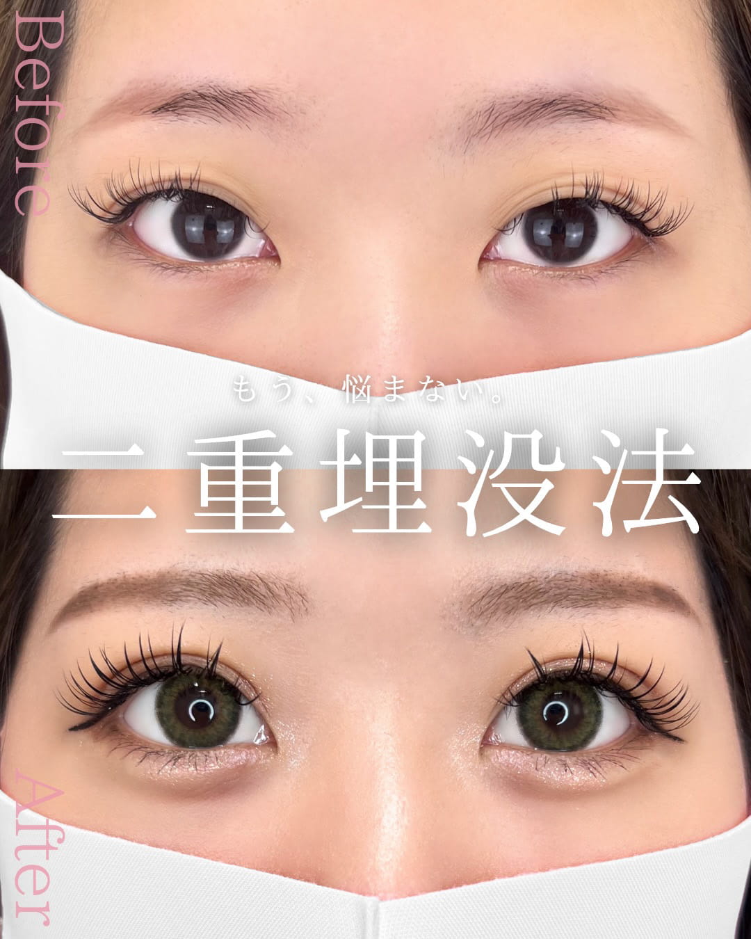 二重埋没の症例写真01