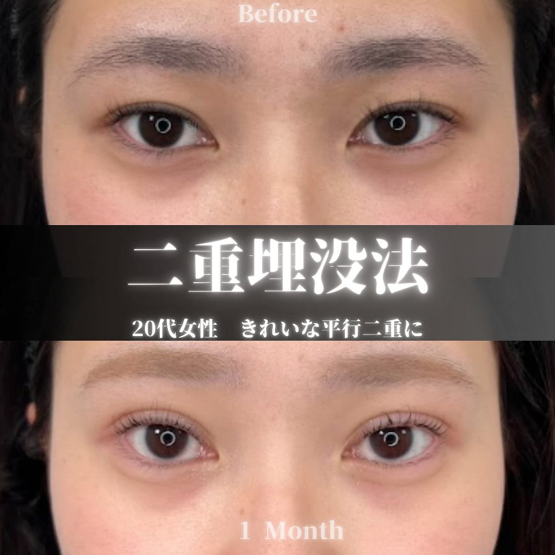 二重埋没の症例写真02