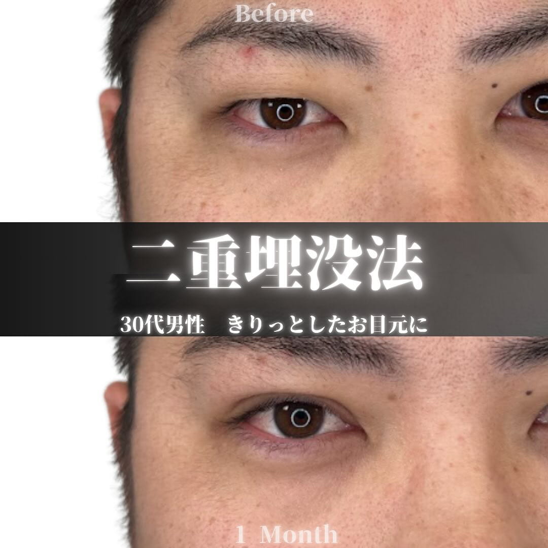 二重埋没の症例写真03