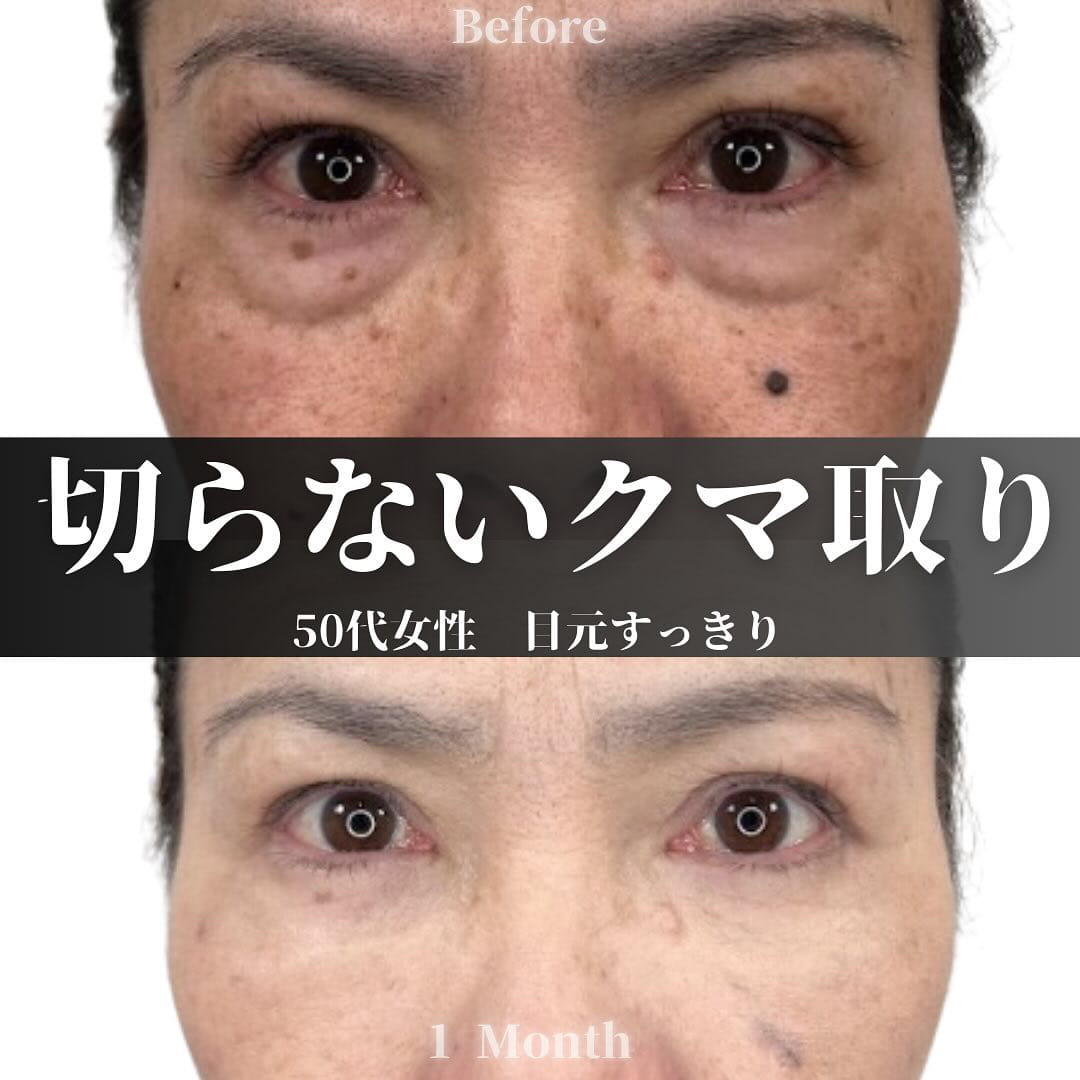 切らない目の下のクマ取り・目の下のたるみ（ふくらみ）取りの症例写真01