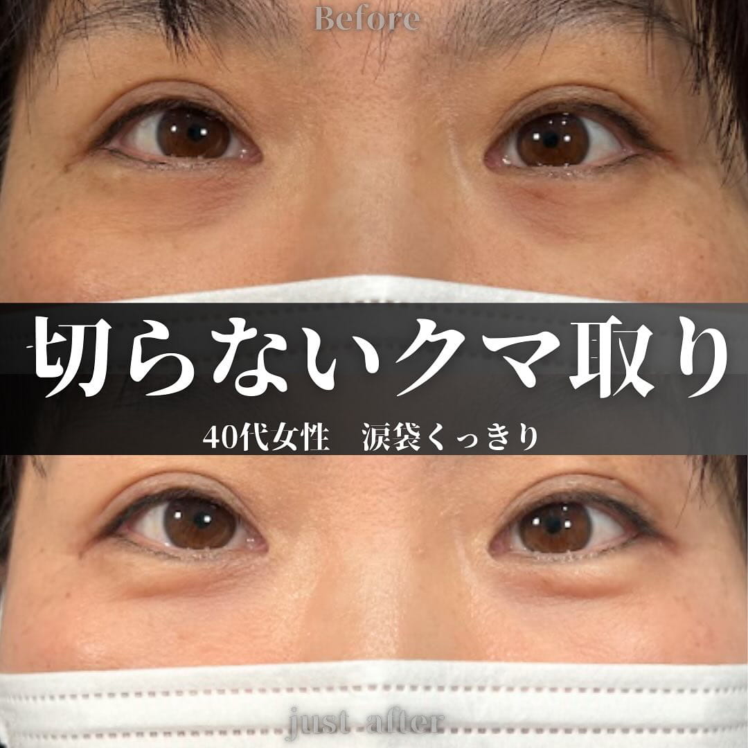 切らない目の下のクマ取り・目の下のたるみ（ふくらみ）取りの症例写真02