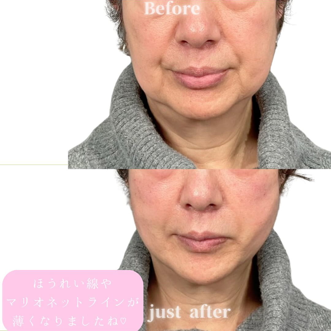 小顔美肌再生の症例写真01