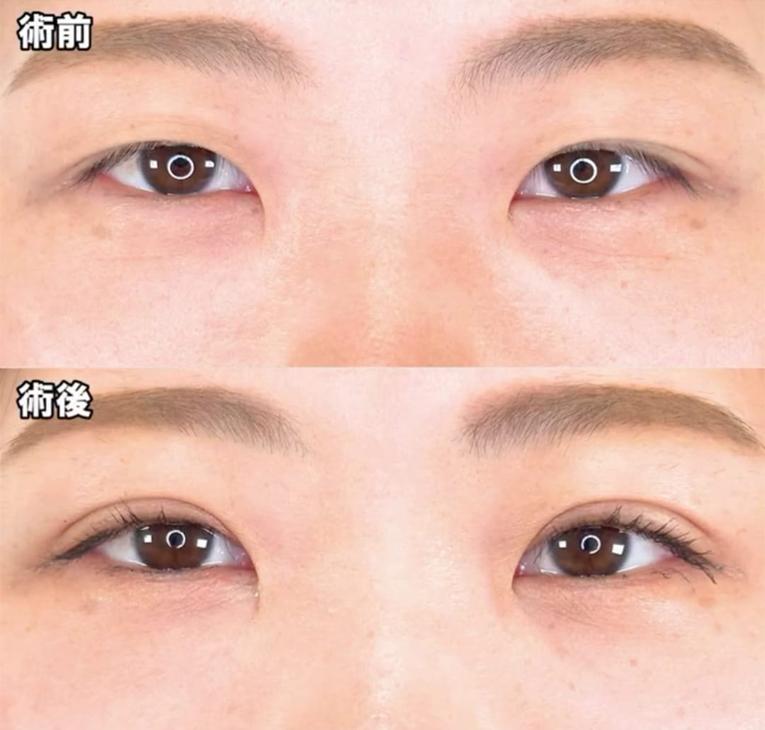 二重埋没の症例写真01