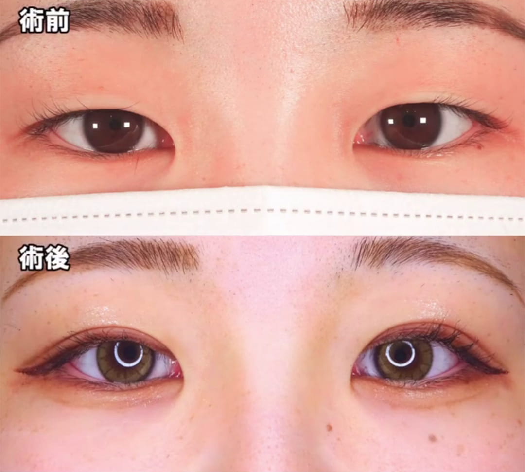 二重埋没の症例写真02