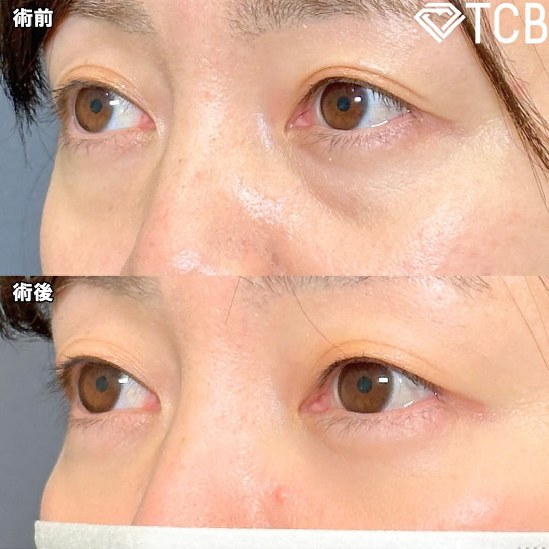 切らない目の下のクマ取り・目の下のたるみ（ふくらみ）取りの症例写真01