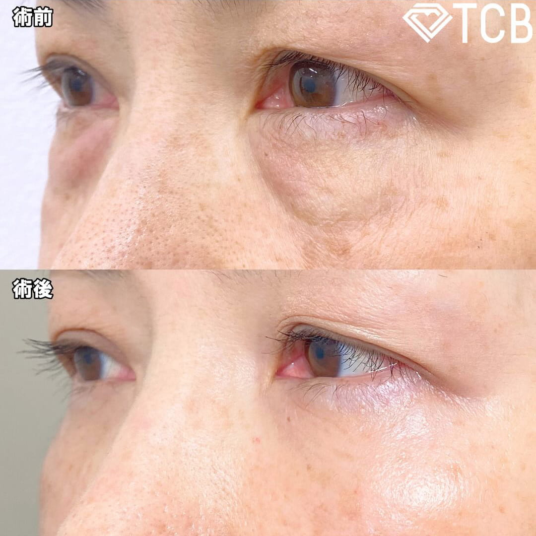 切らない目の下のクマ取り・目の下のたるみ（ふくらみ）取りの症例写真02