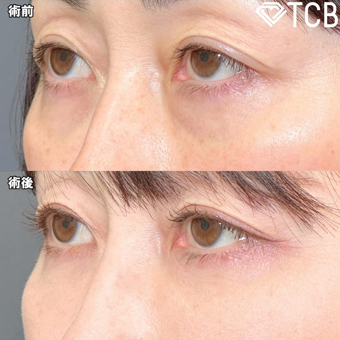 切らない目の下のクマ取り・目の下のたるみ（ふくらみ）取りの症例写真03